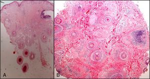 Punch biopsies from a patient with lichen planopilaris. Hematoxylin–eosin, original magnification ×40. A, Longitudinal section. B, Transverse section.