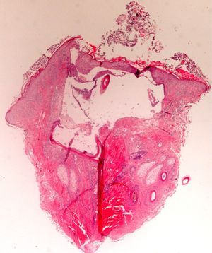 This highly damaged biopsy showed folliculitis, an empty central zone (an artifact caused by a clamp), and a sclerosed area at the bottom of the field (a compression artifact). Hematoxylin–eosin, original magnification ×20.