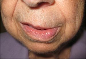 Soft edema in the lower left lip.