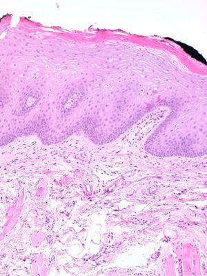 Histology revealed labial edema with slight ectasia of the lymphatic vessels in the specimen, with no granulomatous lesions or other inflammatory lesions (hematoxylin–eosin, original magnification ×10).