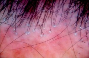 Dermoscopy (Dermlite 00 multispectral) revealed markedly reduced follicular ostia, scale, erythema, and perifollicular blue-gray dots.