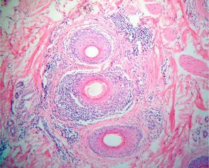 Histopathology revealed a reduction in the number of hair follicles, lymphocytic inflammatory infiltrate, and laminated perifollicular fibrosis (hematoxylin–eosin, original magnification 40×).
