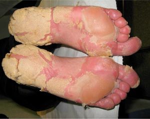 Soles of the feet with marked hyperkeratosis prior to treatment.
