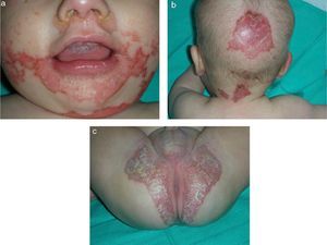 Scaly, erythematous plaques on the face (in a periorificial distribution) (A), on the scalp (B), and in the diaper area (C).