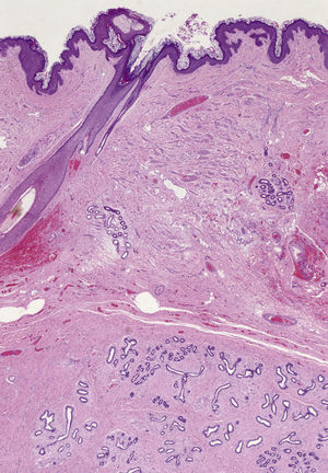 Panoramic microscopic image of the lesion (hematoxylin–eosin, original magnification ×10).