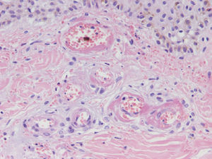 Fibrinoid necrosis of the vascular wall (hematoxylin–eosin, ×40).