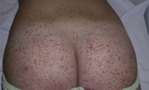 The presence of lesions on the buttocks is common in Henoch–Schönlein purpura.