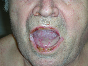Tongue erosions and erosive cheilitis with crusting.