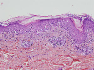 Lichenoid interface dermatitis with necrotic keratinocytes (hematoxylin–eosin, ×100).