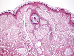 Histologic image of fibrofolliculoma (hematoxylin–eosin, original magnification 100×).