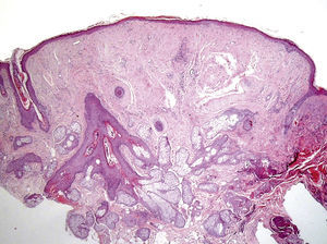 Histologic image of trichodiscoma (hematoxylin–eosin, original magnification 100×).