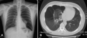 (A) Plain chest X-ray showing left spontaneous pneumothorax in a patient with Birt–Hogg–Dubé syndrome. (B) Chest computed tomography image showing multiple right lung cysts in a patient with the syndrome.