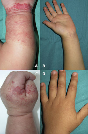 Abortive hemangiomas at the maximum point of growth and after regression. Segmental lesion on the forearm with minimal spread to the wrist at 45 days (A) and 3 years (B) of age. Partially segmental hemangioma on the hand at 45 days (C) and 4 years (D) of age.
