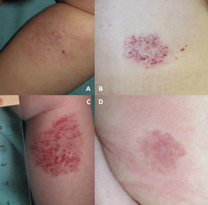 Clinical images of abortive hemangiomas. Pink reticular lesion located on the leg with fine telangiectasis and 4 small red papules on the surface (A). Congenital telangiectasias in normal skin with erythematous papules that appeared after birth predominantly in the peripheral areas of the lesion. Note the pallor around the lesion (B). Central and peripheral proliferation in 25% of the surface area of an erythematous lesion (C). Pale halo surrounding a pink telangiectatic lesion on the buttock (D).