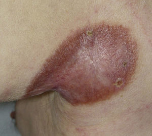 Brownish erythematous plaque located on the posterior aspect of the left axilla, with an atrophic center, raised borders, and telangiectasias.