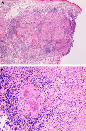 A, Low-power view of the biopsy specimen, showing a dense granulomatous infiltrate in the middle dermis that becomes less severe in the deep dermis (hematoxylin-eosin, original magnification ×40). B, Detail of a noncaseating granuloma with lymphocytic corona and multinucleated giant cells (hematoxylin-eosin, original magnification ×200).