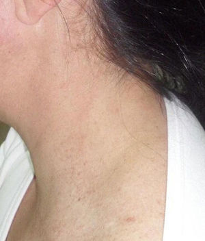 Complete disappearance of lesions after 1 month of topical treatment with 0.1% tazarotene.