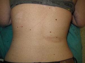 Vitiligo lesions and morphea-like plaque on the back.