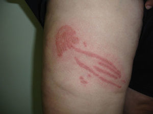 Inflammatory plaque on the leg in the shape of the jellyfish that caused the sting.