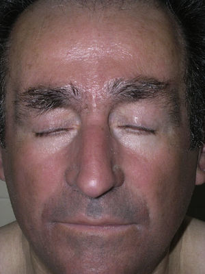Minute skin-colored papules that are waxy to the touch are visible on the forehead. The wrinkles around the eyes and mouth have disappeared as a consequence of mucin deposits in the skin.