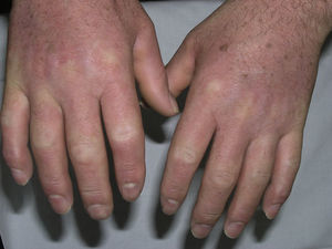 Rigid appearance of the hands and depression over the proximal interphalangeal joint surrounded by redundant skin forming the characteristic donut sign.
