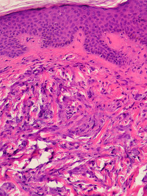 Irregular proliferation of fibroblasts with mucin deposits in the superficial and middle dermis (hematoxylin-eosin, original magnification ×20).