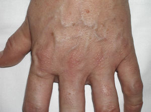 Multiple skin-colored papules (2-3mm in diameter) that are firm to the touch can be observed on the skin covering the metacarpophalangeal joints.