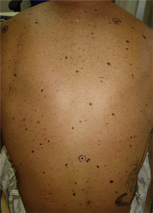 Multiple melanocytic nevi, some of which are atypical, on the patient's back.