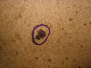 Detail of an atypical lesion that was later removed.
