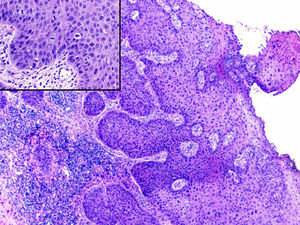 Epidermis with marked acanthosis, epithelial immaturity, cell pleomorphism, and atypical mitotic figures in various strata (hematoxylin-eosin, original magnification ×40; inset ×200).