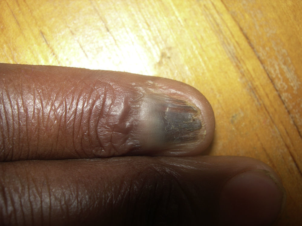 An Atlas of Nail Disorders, Part 5 | Consultant360