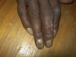 Note the solitary transverse grooves (Beau lines) on a fingernail. Such grooves grow out with the nail.