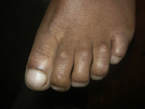 Pallor, in nails with pseudoclubbing.