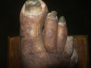 Significantly hypertrophic, hornlike toenail characteristic of onychogryphosis in leprosy.