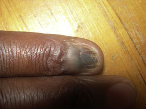 Pterygium unguis and atrophy of the nail plate.