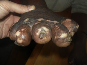 Several of the nail changes that are characteristic of leprosy can be seen in this photograph. Anonychia, spicules, and rudimentary remains of ectopic nails can be seen, and resorption is advanced in a hand that has come to resemble a fin.
