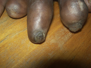Complete absence of a fingernail (anonychia) and rudimentary fingernails on the hands of a patient with leprosy.