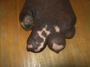 Finlike hand from which fingers have been lost or developed pseudoclubbing and a perforating ulcer on a finger.