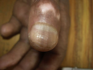 Note the pigmented longitudinal bands running between the lunula and the free margin of the nail bed (longitudinal melanonychia).