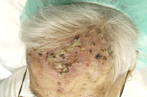 Crusted pustular lesions on the forehead after cryotherapy.
