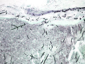 Septate hyphae measuring approximately 2μm in diameter with dichotomous acute-angle branching (45°).