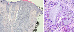A, Histopathology revealed several hair follicles with abundant intraepithelial mucin in the dermis. No accompanying inflammatory infiltrate was observed. B, Detail showing intraepithelial mucin.