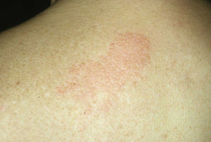 Erythematous papules and plaques on the patient's back.