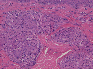 Epithelioid granulomas in the dermis identified in a skin biopsy taken from the patient's back, hematoxylin-eosin, original magnification ×200.