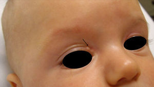 Two lipodermoid cysts on the right upper eyelid.