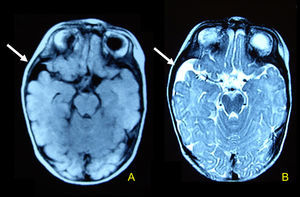 Arachnoid cyst occupying the right temporal fossa. A, brain axial T1-weighted magnetic resonance imaging; B, brain axial T2-weighted magnetic resonance imaging.