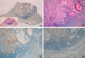 A and B. Keratoacanthoma with malignant transformation to squamous cell carcinoma (SCC) at the center of the lesion and in deep layers. C. Strong staining at the invasive front of SCC (left), absence of staining in the keratoacanthoma area (right). D. Strong staining in the SCC area in deep layers of the keratoacanthoma. (A. Lower-magnification view of laminin-332 staining, inset shows lower magnification view of hematoxylin-eosin [H/E] staining. B. H/E x40. C. Laminin x40. D: Laminin x100.) The asterisks indicate amplified areas.