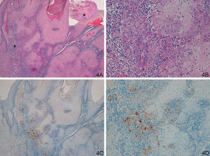 A and B. Keratoacanthoma with an area of incipient squamous cell carcinoma (SCC). C and D. Focal but strong staining in the region of incipient SCC. (A: Hematoxylin/eosin [H/E] x40, inset shows lower-magnification view of H/E. B. H/E x200. C. Laminin x40. D. Laminin x100.) The asterisks indicate amplified areas.