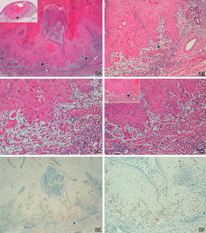 A-D. Histologically ambiguous lesion; keratoacanthoma in active regression with possible incipient squamous cell carcinoma in some areas. E-F. Weak focal staining in isolated cells, similar to the keratoacanthomas. (A. Hematoxylin/eosin [H/E] x40, inset shows lower-magnification view of H/E staining. B and C. H/E x100 and H/E x200. D. H/E x200, H/E x100 in inset. E. Laminin x40. F: Laminin x100). The asterisks indicate amplified areas.