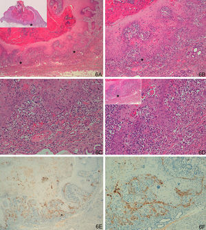 A-D. Possible incipient squamous cell carcinoma in the deep layers of a keratoacanthoma in active regression. E and F. Staining for laminin-332 at the invasive front, with squamous type staining pattern, although weaker than the other cases of SCC. (A: Hematoxylin/eosin staining [H/E] x40, inset shows lower-magnification view of H/E staining. B and C. H/E x100 and H/E x200. D. H/E x200, H/E x100 in inset. E. Laminin x40. F. Laminin x100.) Asterisks show amplified areas.